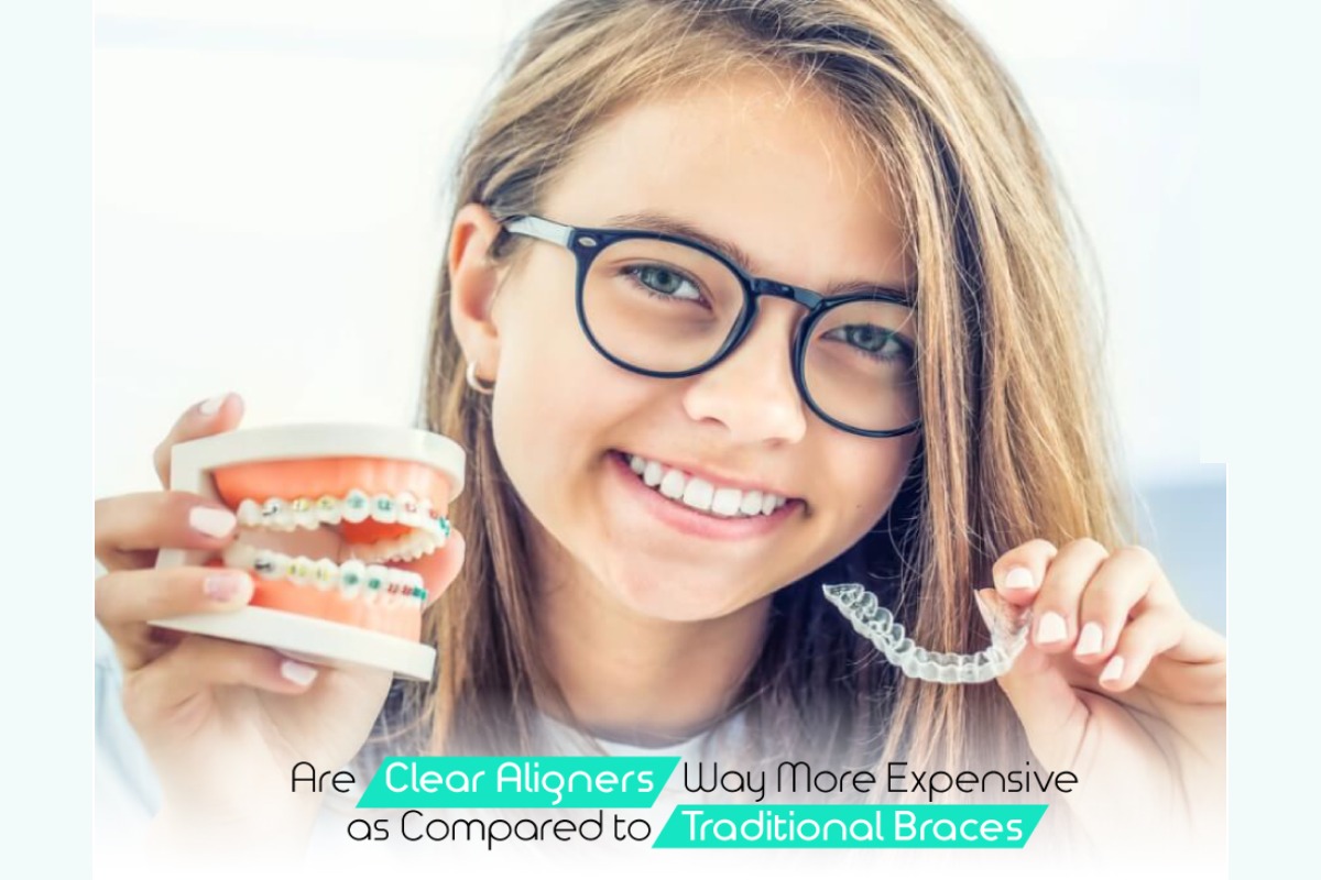 Clear Aligners Way More Expensive As Compared To Traditional Braces