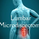 Lumbar Microdiscectomy