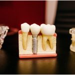 Questions to Ask Before Getting a Dental Impact
