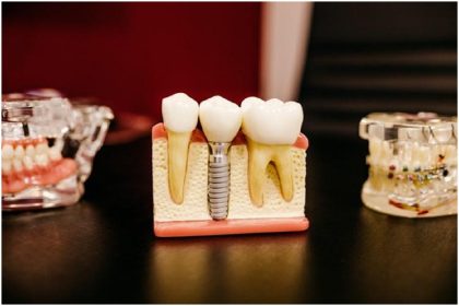 Questions to Ask Before Getting a Dental Impact