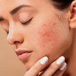 How Do You Clear Up Rosacea