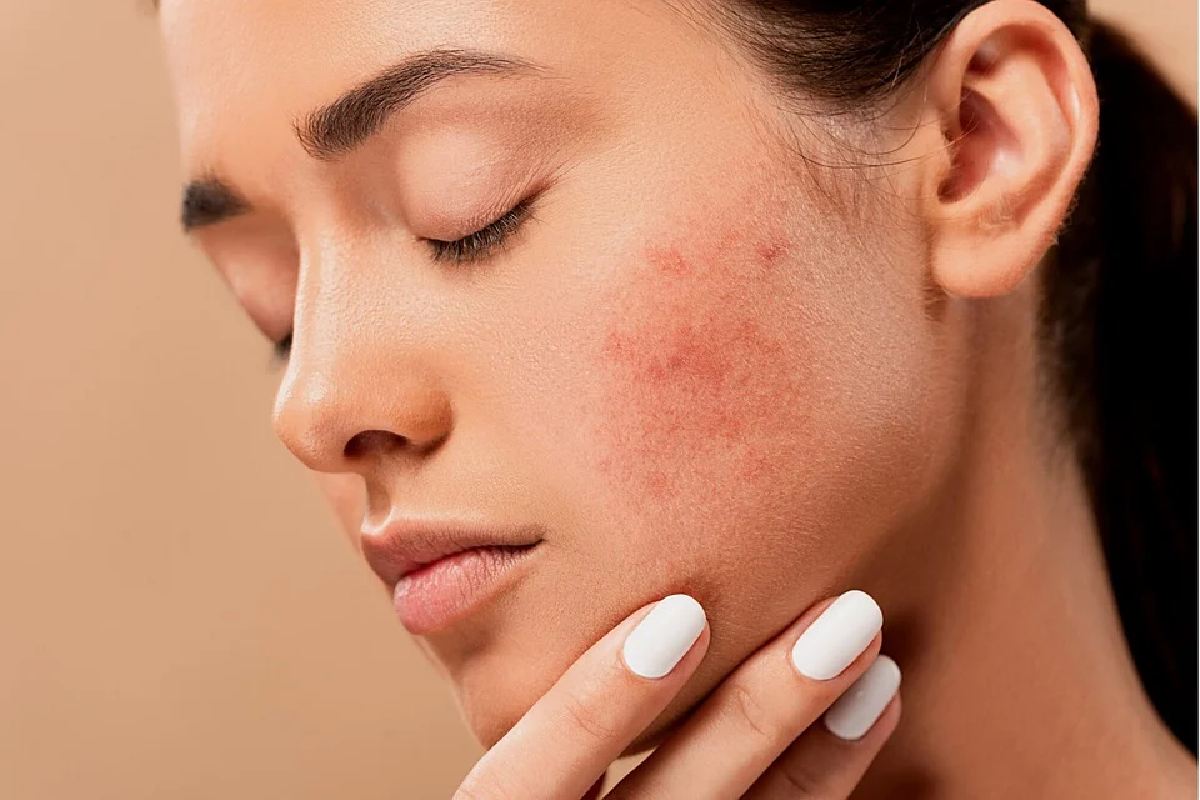 How Do You Clear Up Rosacea