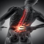 What Is Herniated Discs