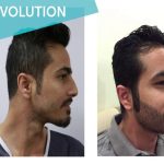 Beard Transplant Turkey - Dr. Serkan Aygin Clinic