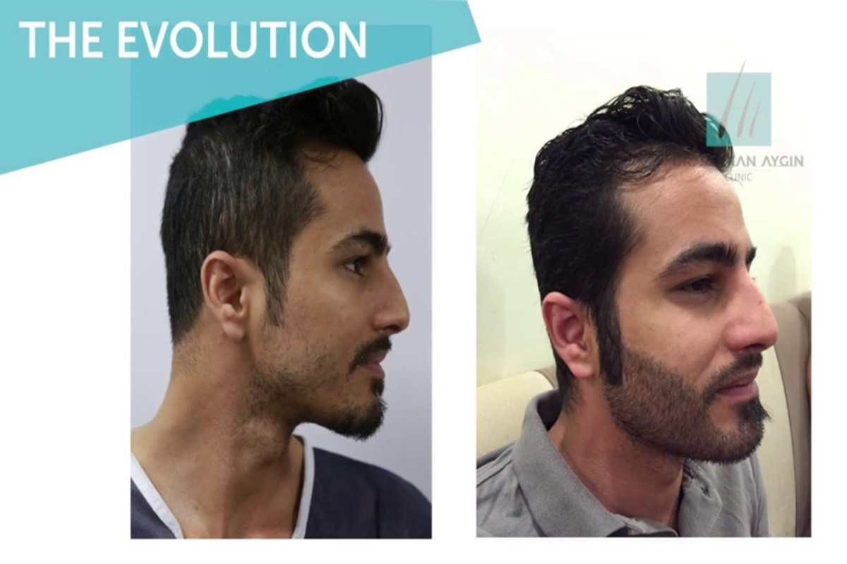 Beard Transplant Turkey - Dr. Serkan Aygin Clinic
