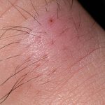 Ingrown Hair