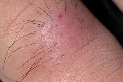 Ingrown Hair