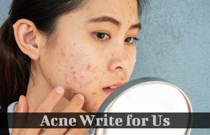 Acne Write for Us, Guest Posting, Contribute, and Submit Post