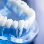 Pinnacle of Dental Perfection_ Teeth Implants in Beverly Hills, CA