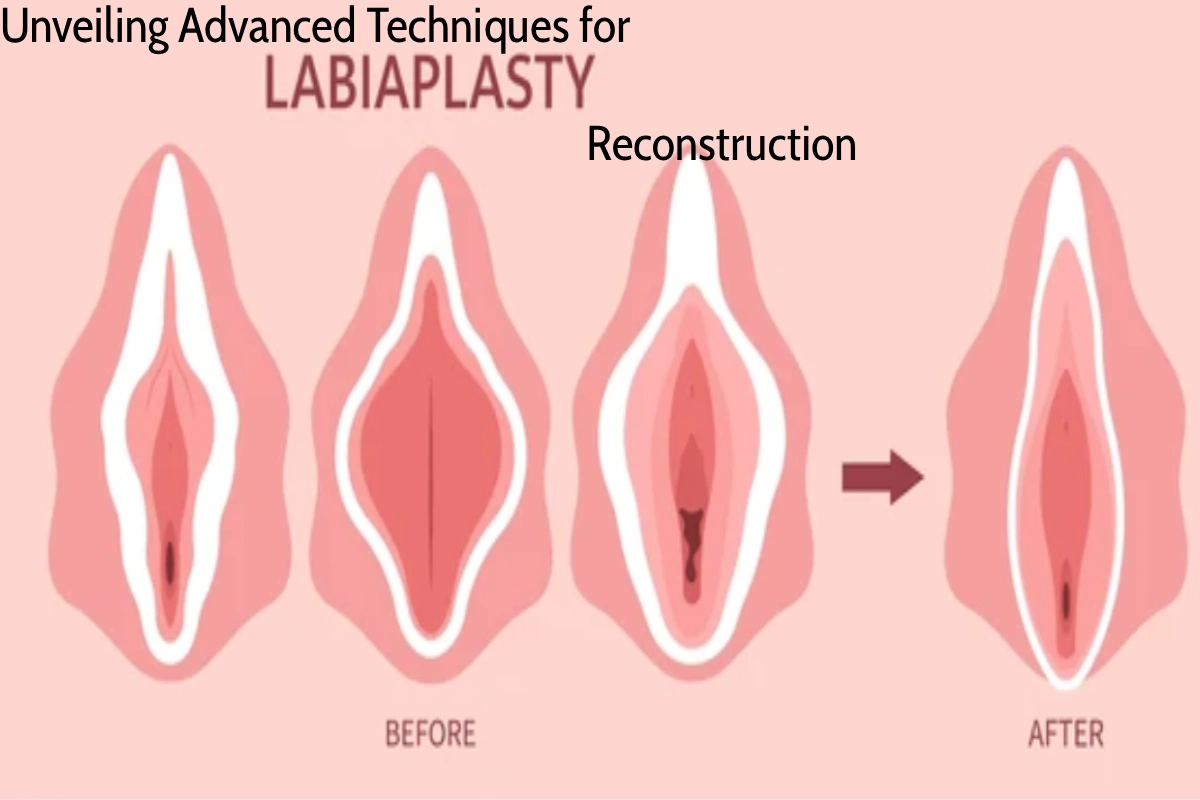 Unveiling Advanced Techniques for Labia Reconstruction