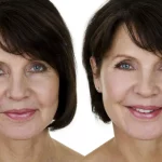 Vertical Facelift Surgery in Beverly Hills