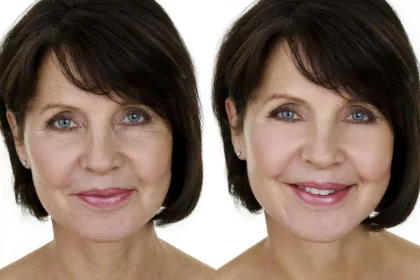 Vertical Facelift Surgery in Beverly Hills