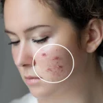 What Medi Spa Treatment is Best For Your Type of Acne Problem_