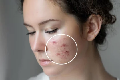What Medi Spa Treatment is Best For Your Type of Acne Problem_