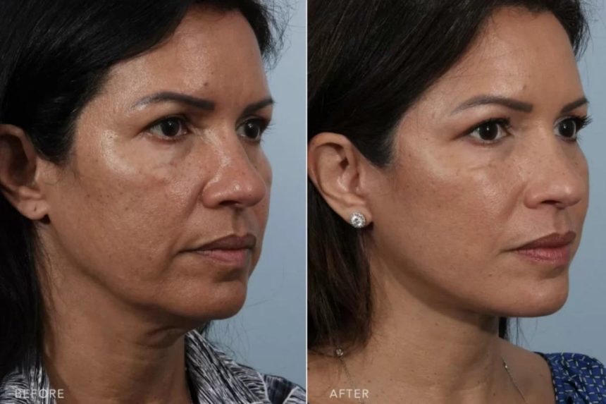 How Long Do Facelift Results Last_
