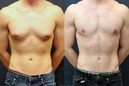 Gynecomastia Surgery