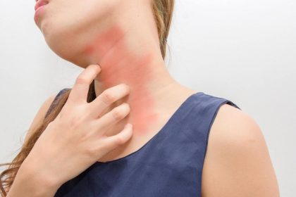 histamine intolerance what you should know