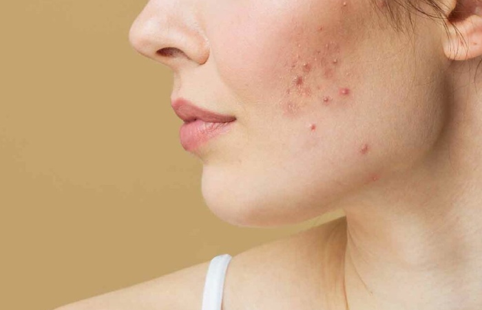 Acne Write for Us, Guest Posting, Contribute, and Submit Post